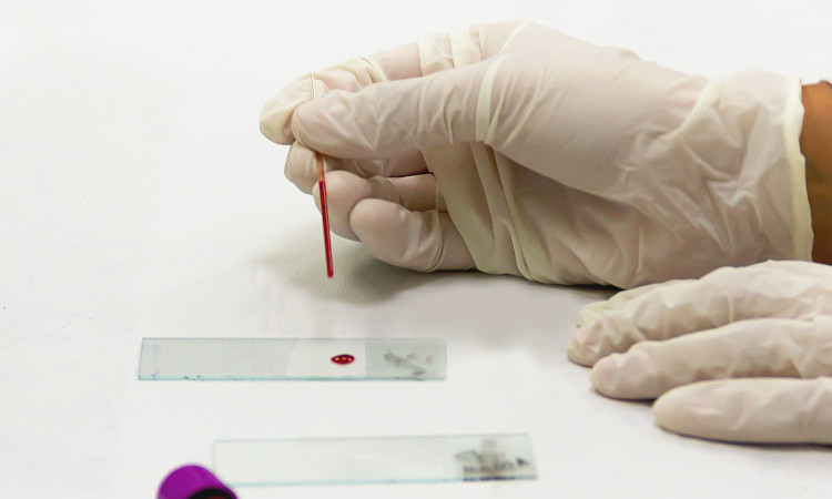 Mão com luva cirúrgica branca fazendo teste de ISTs sem sintomas, colocando gota de sangue em placa petri.