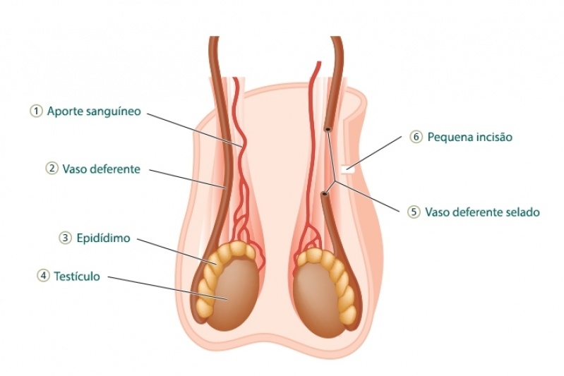 clinica para cirurgia de vasectomia onde encontrar