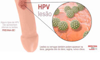 o que é hpv