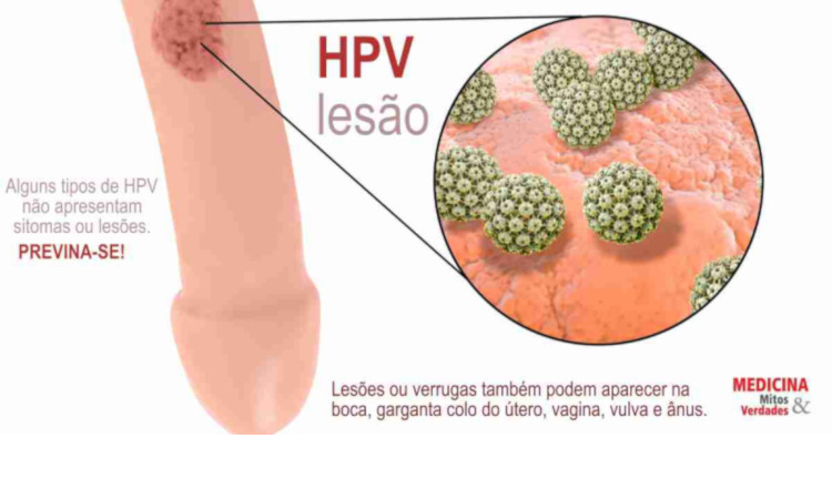 HPV