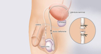 Cirurgia de Vasectomia